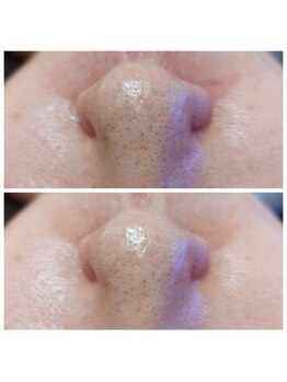 ラ ドウ 名古屋黒川店(la.dow)/気になる小鼻の黒ずみ