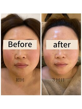 ミピマムマール(Mipimam Maaru)/お客様before→after