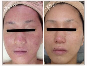 ミューベル(MYubelle)/赤み改善 水光ピーリング