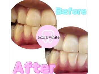 エクシアホワイトニング 新白河店/ホワイトニングビフォーアフター