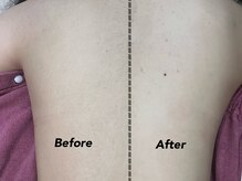 クイーン(QUEEN)/ぽわぽわうぶ毛撃退