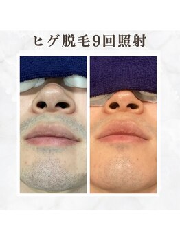 ボゴス 天白店(BOGOSS)/【ヒゲ脱毛】
