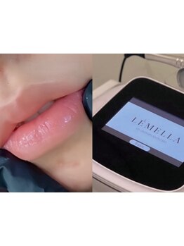 メンズフェイシャル