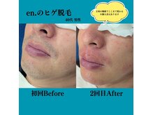 髭脱毛に特化したサロンです　