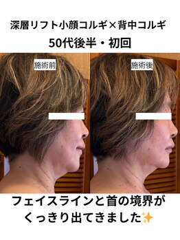 エミニナル(EMININAL)/深層リフト×背中コルギ