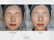 メルト 中目黒(Melt.)/◇ララピール×サーマジェン