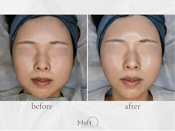 メルト 中目黒(Melt.)/◇ララピール×サーマジェン