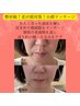【老け顔対策・ほうれい線】筋膜リリース小顔リンパマッサージ60分¥13200