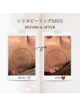 エクラ アン(eclat.un)/40代女性：シリカピーリング