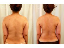 ミールーム(mi room)/痩身エステ数ヶ月