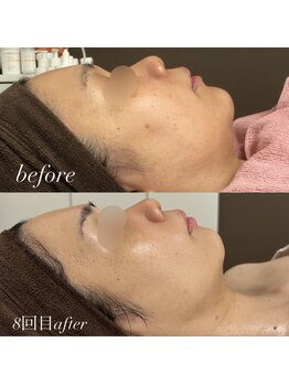 シーラックス(Sealax)/リフトアップ×肌質ケアも◎