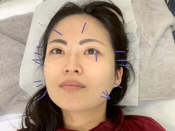 寝屋川かわい鍼灸整骨院の写真/【美容鍼×全身整体】で美肌アップ/肩こり改善整体8000円/15分のヘッドスパつき