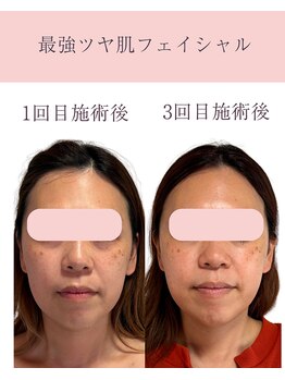 シンナリ(Shinnari)/最強ツヤ肌フェイシャル