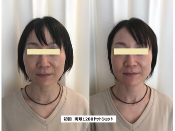 ナチュレアンドメディカ(Nature&Medica)/【たるみor小顔】ウルトラリフト