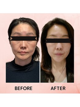 スーコ(SU:CO)/ビフォアフ　驚！エアバリ二日後