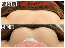 ちゅるん肌ドットコム 喜連瓜破店(ちゅるん肌.com)/ BBLバストアップ８回の変化 