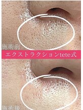 毛穴屋/毛穴洗浄毛穴エクストラクション