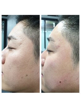 エピシア(EPICIA)/メンズにもハーブピーリング人気