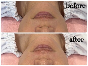 シルク(Cilk)/バラ成分配合最上級ピーリング