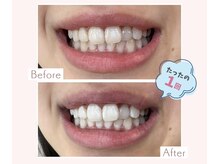 エクシア ホワイトニング 伊勢崎店/