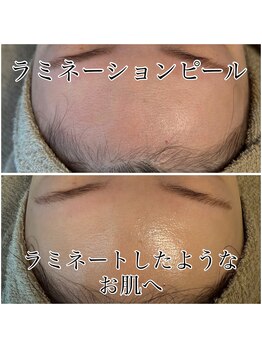 ゆでたまご/次世代ピーリング