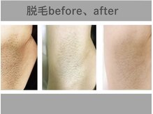 リル シャイン(Rill SHINE)/レディースワキ脱毛