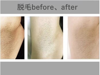 リル シャイン(Rill SHINE)/レディースワキ脱毛