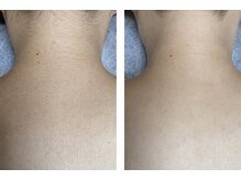 レティティア(Laetitia)/うなじ＆背中脱毛