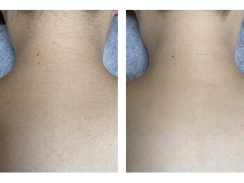 レティティア(Laetitia)/うなじ&背中脱毛