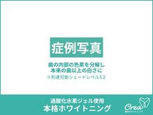 クレア(Crea)/【ホワイトニング症例写真】