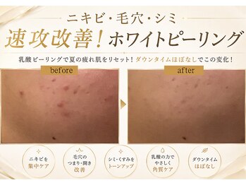 ホリスティックエステ/イーズ ピオレ姫路店の写真/【韓国水光肌ホワイトピーリング￥5,500】秋美肌ケアで透明感UP♪毛穴開き黒ずみ＆シミケアにこ効果◎