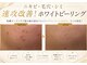 ホリスティックエステ/イーズ ピオレ姫路店の写真/【韓国水光肌ホワイトピーリング￥5,500】秋美肌ケアで透明感UP♪毛穴開き黒ずみ＆シミケアにこ効果◎