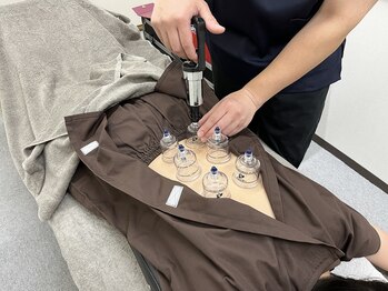 ボディメイク アールエフ サクラ接骨院(bodymake RF SAKURA接骨院)/施術（カッピング/吸玉/腰痛）