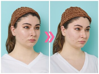 スピード小顔 渋谷店 (Speed)/体験ビフォーアフター