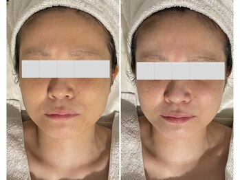 プライベートエステティックサロン クール(Coeur)/【たまご肌シルキー脱毛コース】