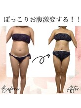 サロン ド ボーテ ラーンジュ 岐阜店(salon de beaut'e L'ange)/ハイパ-ナイフEX2ダイエット痩身