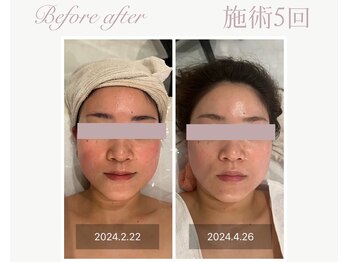 パルタージュ(Partage)/透明肌／白玉水光肌フェイシャル