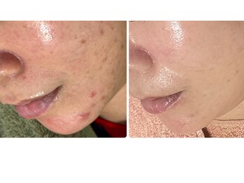 ゆらり/乾燥・ニキビ・毛穴ケア