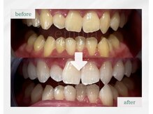【福岡市南区唯一の歯科ホワイトニング専門店】before→after