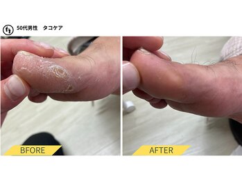 ふっとけ庵/足裏角質、たこケア