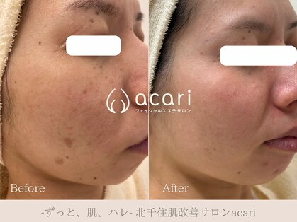 アカリ(acari)の写真