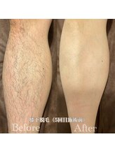 ミノア 熊本店(MINOA)/メンズ◆膝下脱毛