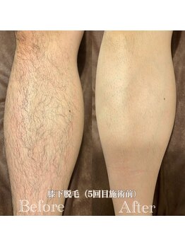 ミノア 熊本店(MINOA)/メンズ◆膝下脱毛