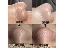 ビューティーネイル(Beauty Nail)/毛穴エクストラクション