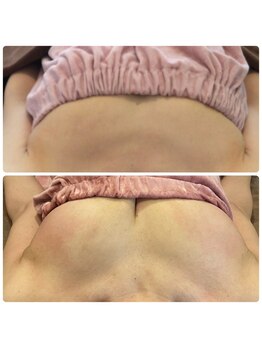 サチ(Sachi)/産後のデコルテガリガリが嫌です