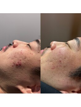 アノネ(Anone.)/韓国美容プラズマ症例