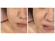 ティープラス 大和鶴間店(T-PLUS)/小顔毛穴エステ/ビフォアフター