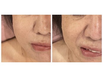 ティープラス 大和鶴間店(T-PLUS)/小顔毛穴エステ/ビフォアフター