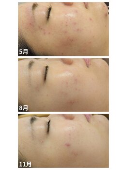 ラミーユ(La Miu)/ハーブピーリング/京都山科椥辻