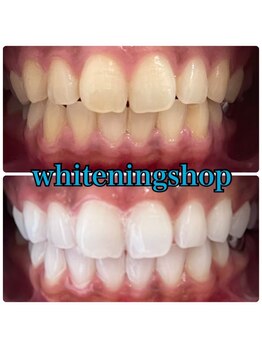 ホワイトニングショップ 越谷店/